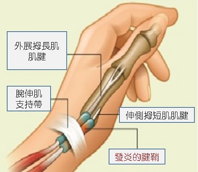 媽媽手 林新醫院