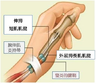 3D水針刀  '金門美兆診所'tendinitis媽媽手