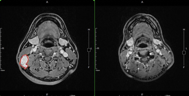 江先生鼻咽癌轉移到頸部淋巴的6公分腫瘤（圖左紅圈處）經放化療成功縮小到看不到。（記者蔡淑媛翻攝）
